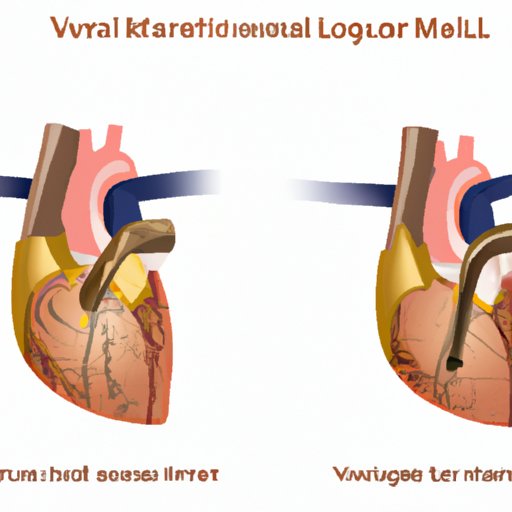 Mitral Valve Surgery: Correcting Issues in the Valve Regulating Blood Flow Between the Left Atrium and Left Ventricle