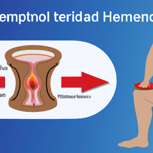 VII. Hemorrhoid Treatment: How to Stop Bleeding and Reduce Painful Symptoms