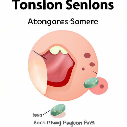 What Are Tonsil Stones? Causes, Symptoms, and Treatment Options