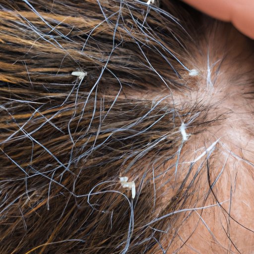 How to Check Yourself for Lice: A Step-by-Step Guide