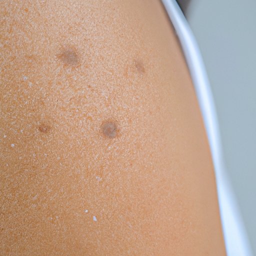 How to Identify Scabies: Signs, Symptoms & More