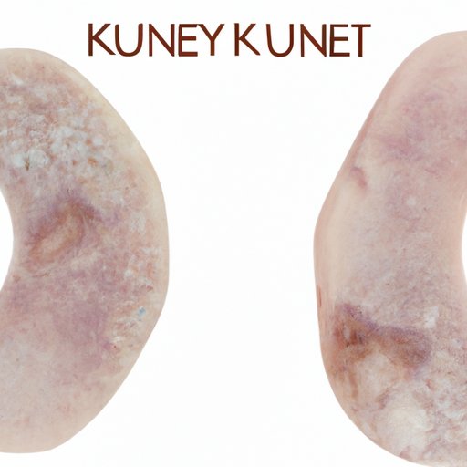 How to Pass a Kidney Stone in 24 Hours: Tips and Remedies