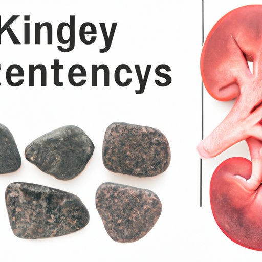 How to Pass Kidney Stones Fast: The Ultimate Guide
