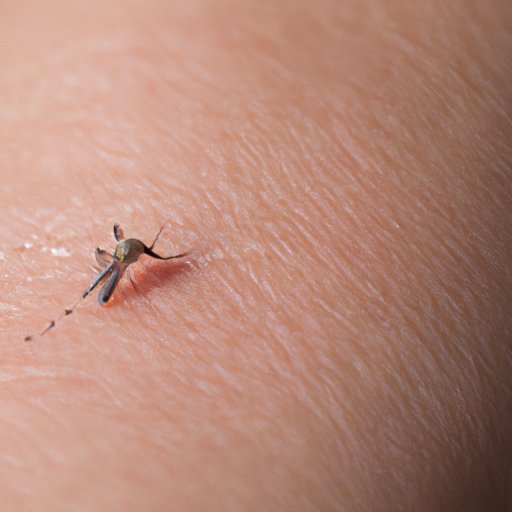 How to Treat Mosquito Bites: Relief and Prevention