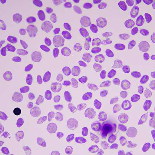 The Link Between Elevated Reticulocyte Count and Blood Disorders: Understanding the Significance of Reticulocyte Counts
