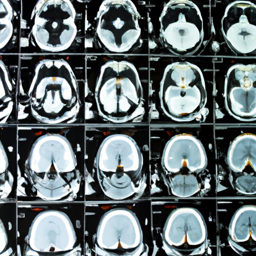 MRI vs CT Scan for Brain: Which One to Choose?
