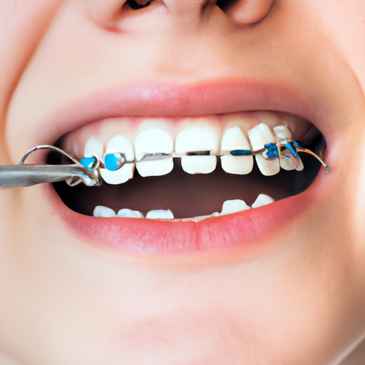 Why Are Braces So Expensive: A Comprehensive Analysis